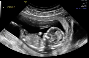 Ewok's ultrasound